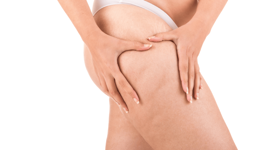 CELLULITE TREATMENT